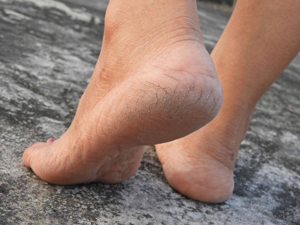 How to Get Dead Skin Off Your Feet