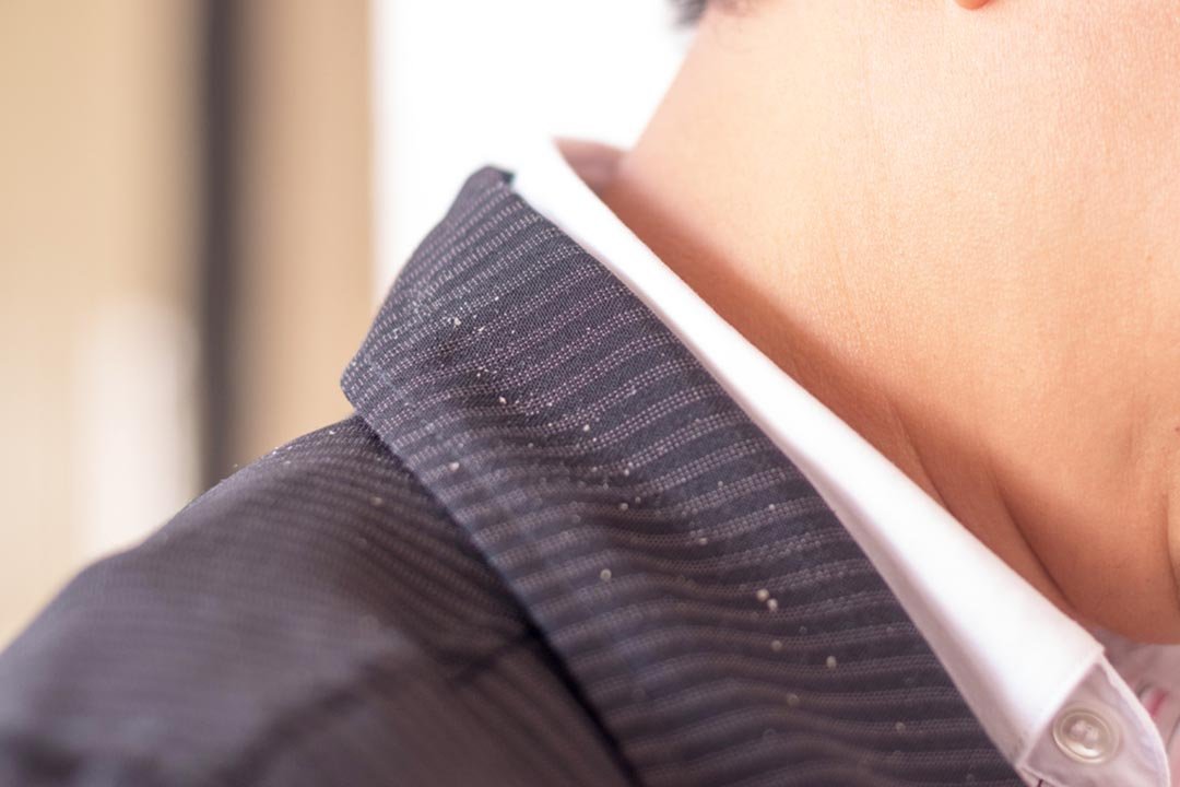dandruff on jacket collar