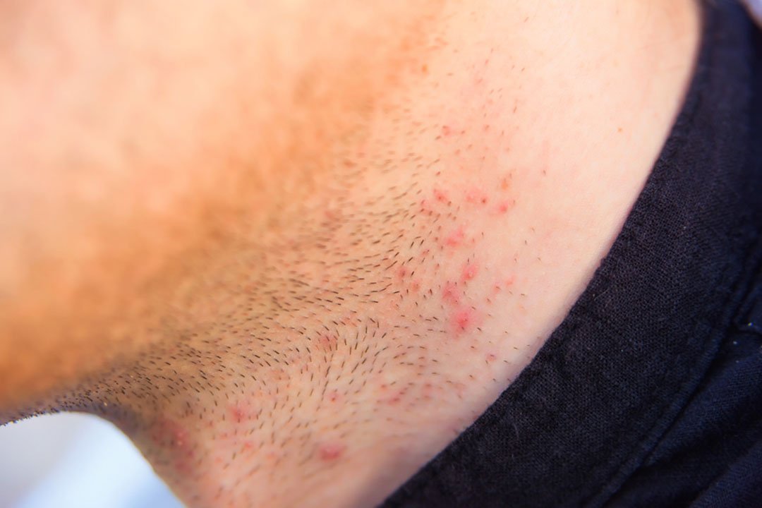 shaving irritation on neck